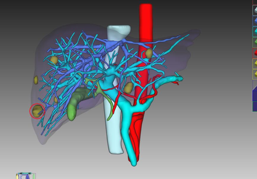 術前全量化三維重建。