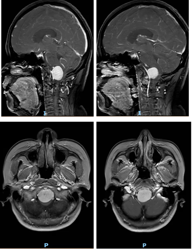 罕見腫瘤深藏“生命中樞”風險極高。